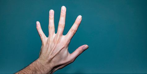 Left Hand With Broken Finger And Ganglion Cyst