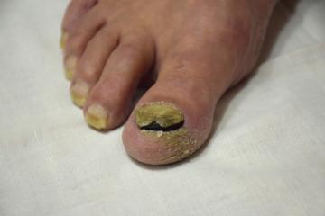 Fungal Nail Disease on the left Leg, front view. Close up of nail fungus infection on the fingers. Fungal infection on nails leg, fingers with onychomycosis.