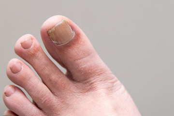 Male Foot onychomycosis with fungal nail infection © Stephen Davies