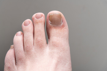 Male Foot onychomycosis with fungal nail infection
