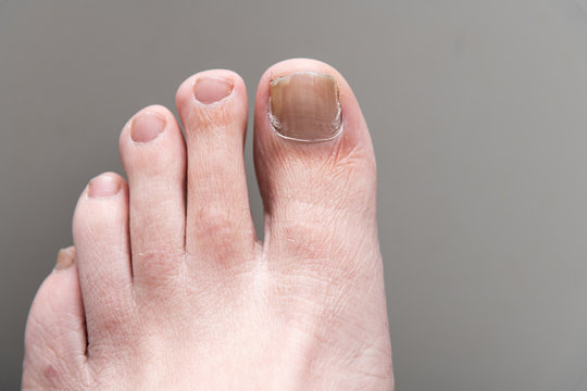 Fungal Nail Infection. Onychomycosis or tinea unguium. Four