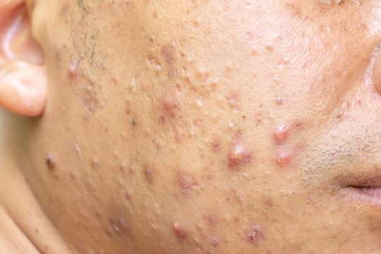 Close up photo of nodular cystic acne blemish spots skin on man face