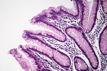 Histopathology of chronic superficial gastritis, light micrograph, photo under microscope