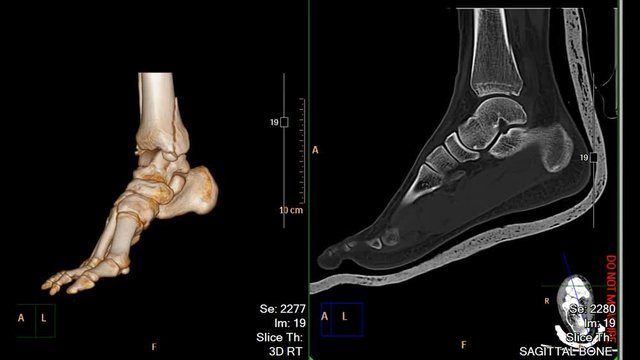 CT Foot or Scan of both foot  3D rendering imagecomparison 3D image and 2D sagittal view showing fracture of distal tibia bone.