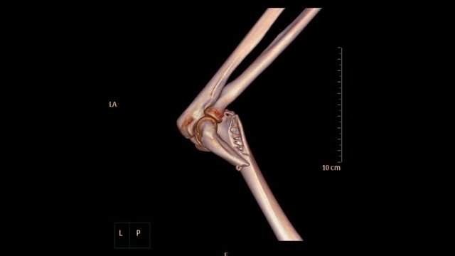 CT Elbow 3D rendering image showing fracture of distal humerus bone.