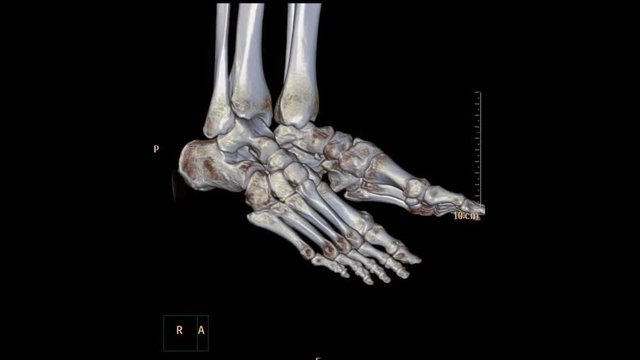 CT Foot or Scan of both foot  3D rendering image rotating on the screen showing fracture of distal tibia bone.