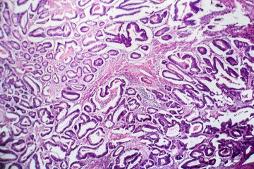 Colon cancer, light micrograph, photo under microscope
