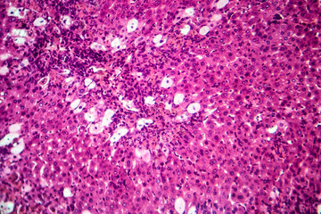 Viral hepatitis, light micrograph, photo under microscope