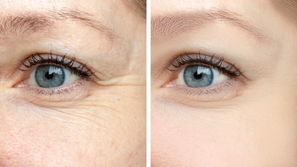 Woman face, eye wrinkles before and after treatment - the result of rejuvenating cosmetological procedures of biorevitalization, botox and pigment spots removal - obrazy, fototapety, plakaty