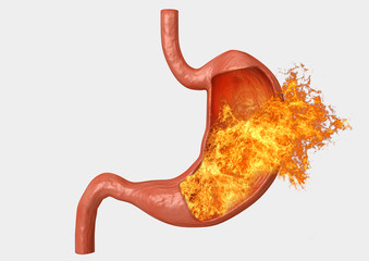 stomach fire. excessive acidity, indigestion, stomach disease, gastric ulcer, severe abdominal pain - obrazy, fototapety, plakaty