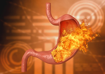 stomach fire. excessive acidity, indigestion, stomach disease, gastric ulcer, severe abdominal pain - obrazy, fototapety, plakaty