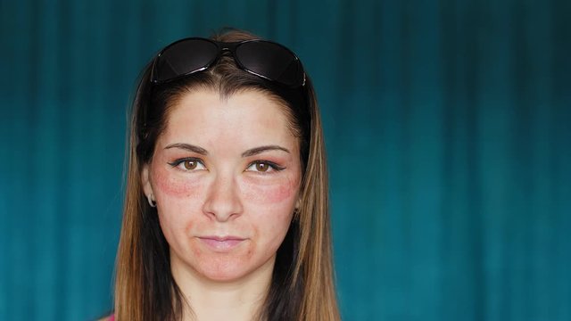 The girl with hematomas on a face. Fractional laser. Consequences of the cosmetology procedure. The woman takes off her dark glasses covering the bruise.