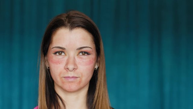 The girl with hematomas on a face. Fractional laser. Consequences of the cosmetology procedure. The woman takes off her dark glasses covering the bruise.