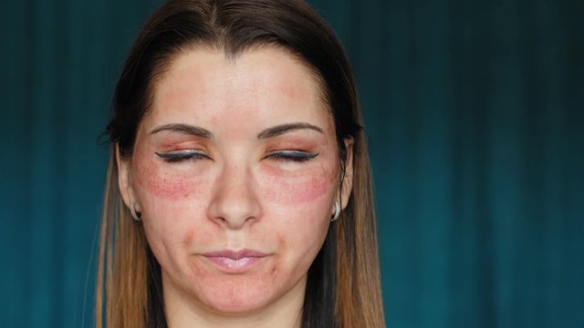 The girl with hematomas on a face. Fractional laser. Consequences of the cosmetology procedure. The woman feels her swollen face.