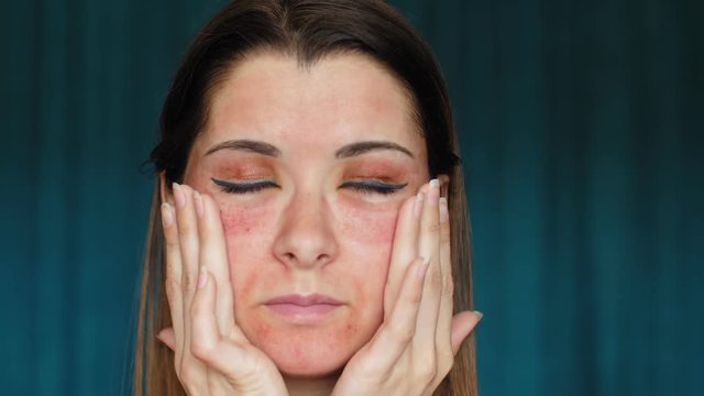 The girl with hematomas on a face. Fractional laser. Consequences of the cosmetology procedure. The woman feels her swollen face.