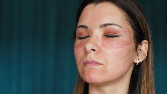 The girl with hematomas on a face. Fractional laser. Consequences of the cosmetology procedure. Woman moisturizing face healing drug. Spray