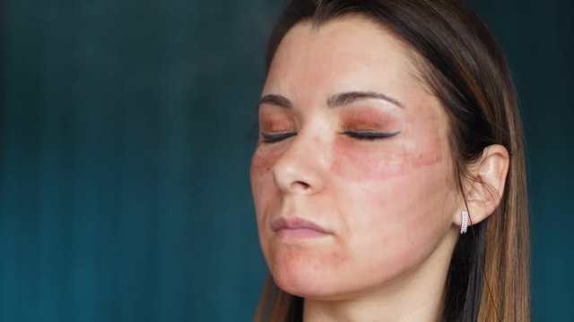 The girl with hematomas on a face. Fractional laser. Consequences of the cosmetology procedure. Woman moisturizing face healing drug. Spray. Slow motion