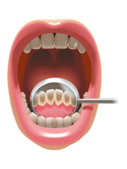 前歯の裏が汚れている