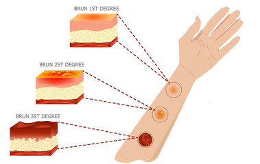types of burns Vector illustration