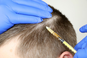 Hair mesotherapy or hair transplant: a beautician doctor makes injections in the man’s head for...