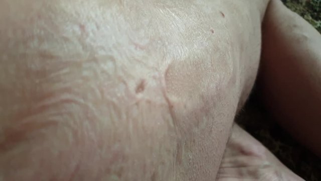 The Burns on the human body.Scar from burns on the body. Wounds on the body.