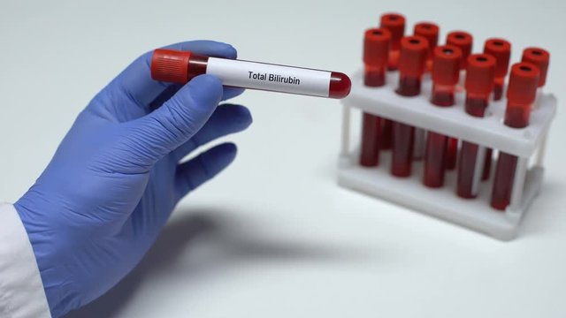 Total bilirubin, doctor shows blood sample in tube, lab research, health checkup