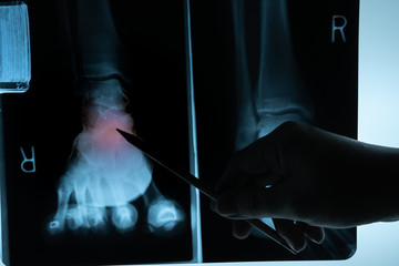 X-ray film with doctor's hand