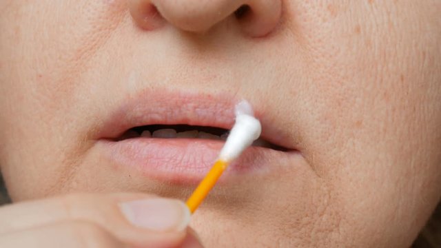 woman is treating herpes on lips by ointment, herpes blisters on female lips closeup