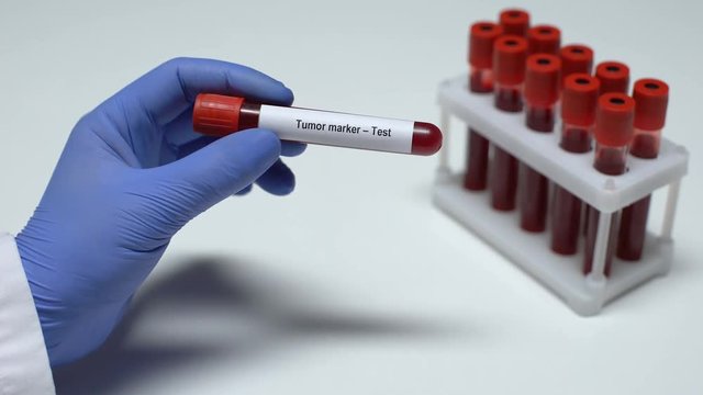Tumor marker, doctor showing blood sample in tube, lab research, health checkup