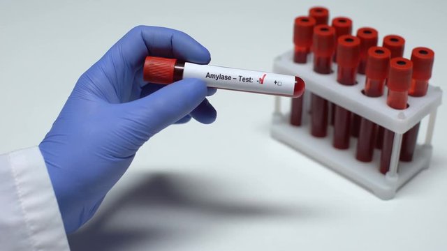 Negative Amylase test, doctor showing blood sample, lab research, health checkup