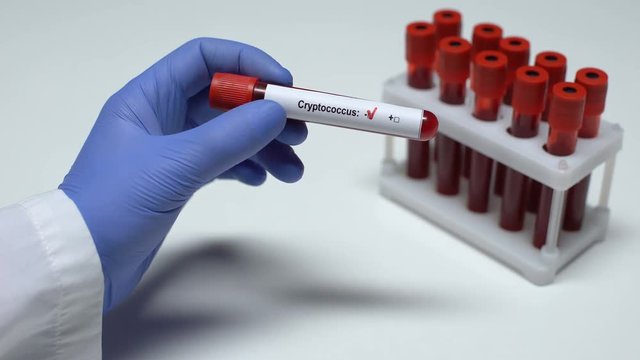 Negative Cryptococcus test, doctor showing blood sample in tube, health checkup