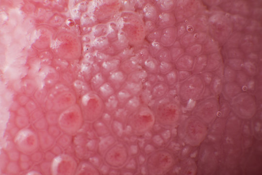 Super macro surface of tongue candidiasis overgrowth