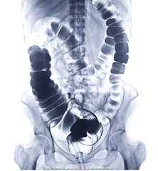 barium enema or BE is image of large bowel by injection of barium contrast into rectal  .This coats...