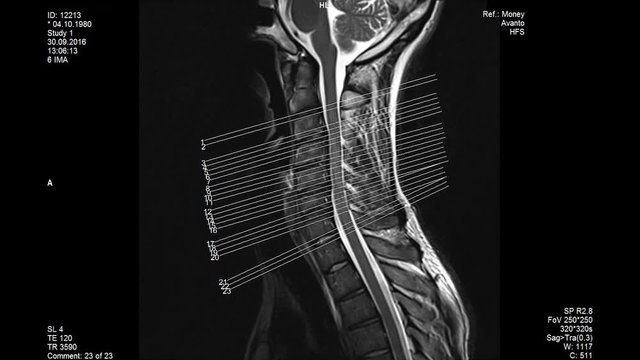 MRI scans, lumbar spine showing sizes