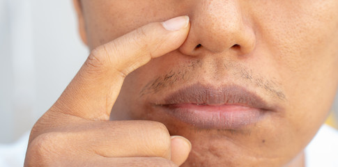 Acne problems on the nose of men
