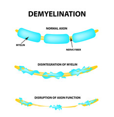 The destruction of the myelin sheath on the axon. Damaged myelin. Neuron affected by multiple sclerosis. World Multiple Sclerosis Day. Infographics. Vector illustration on isolated background.