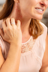 Blond woman feeling awful having rash and reddening on neck