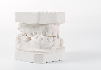Dental casting gypsum model of human jaws. Crooked teeth and distal bite. Shots were made before...