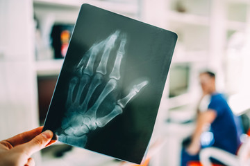 X-ray picture of a hand with a broken little finger, the concept of a neurosurgeon.