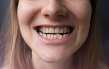 Obraz premium Crooked teeth in the woman's mouth. Dental decay and bad smile. Dentist treatment concept.