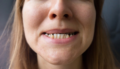 Crooked teeth in the woman's mouth. Dental decay and bad smile. Dentist treatment concept.