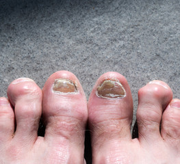 ugly male feet and toes affected by toe nail fungus and arhtritic hammertoes