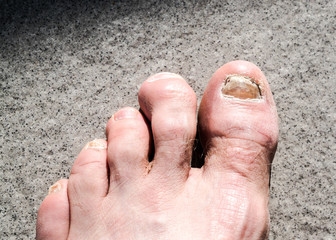 ugly male feet and toes affected by toe nail fungus and arhtritic hammertoes