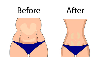 The figure is obese and normal. The problem of excess weight.