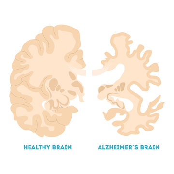 Healthy And Alzheimer Brain. Neurodegeneration Concept Illustration