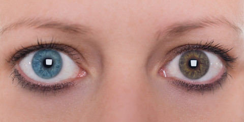 Frau mit Heterochromie, Augenfarbe blau und braun, Kontaktlinsen
