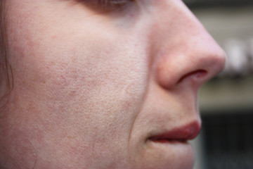 blackheads and large pores. skin care of a teenage Italian girl
