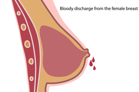 Bloody discharge from the female breast. Mammary gland.
