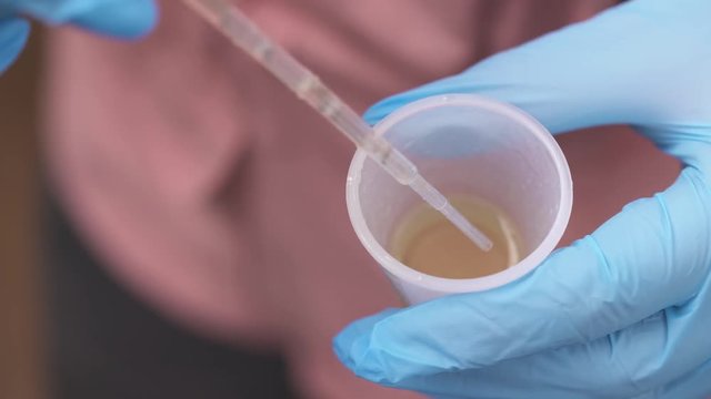 A top view video of a hand in blue medical latex gloves taking a sample of urine from the container.