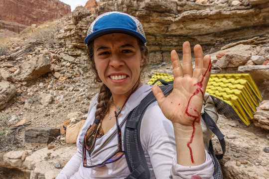 Woman with injured hand while hiking in Grand Canyon, Arizona, USA